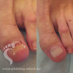 Протезирование после травмы ногтя
